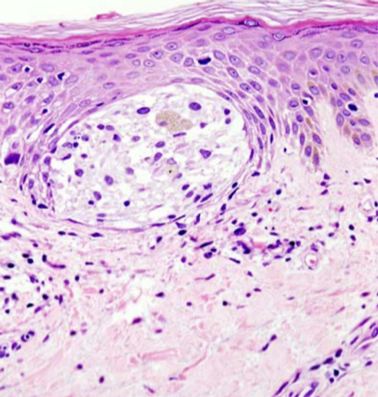 Malignant_melanoma_(1)_at_thigh_Case_01_edited.png