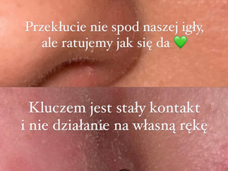 bąbel z limfą jak się pozbyć