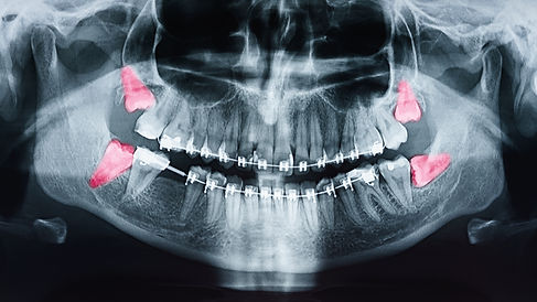 Wisdom Teeth.jpeg