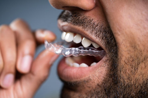 Cosmetic Braces Blk Man.jpeg
