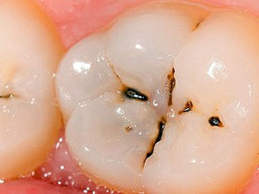 ¿Qué es la caries dental?