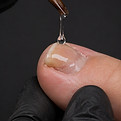 Toenail Restoration