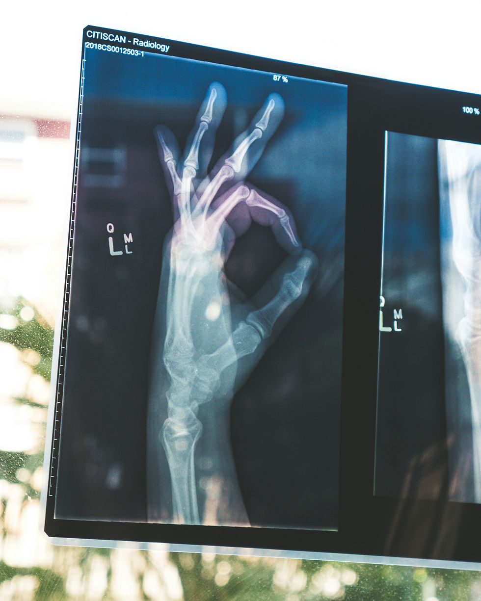 Burnout as a image: a hand in an X-ray with the "A OK" gesture when having to take an X-ray probably means you're not actually ok.