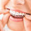 Thumbnail: LITE Invisalign® Treatment - Credit Card Payment