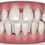 Thumbnail: CLINCHECK SETUP by The Smile Dentist - Dr. Bruno Paliani