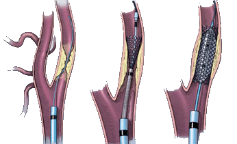 Frederico Linhares - Cirurgia vascular - Angiologista- Fortaleza