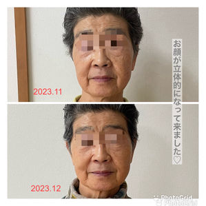 お顔は立体的に、目の下のたるみも改善が始まりました