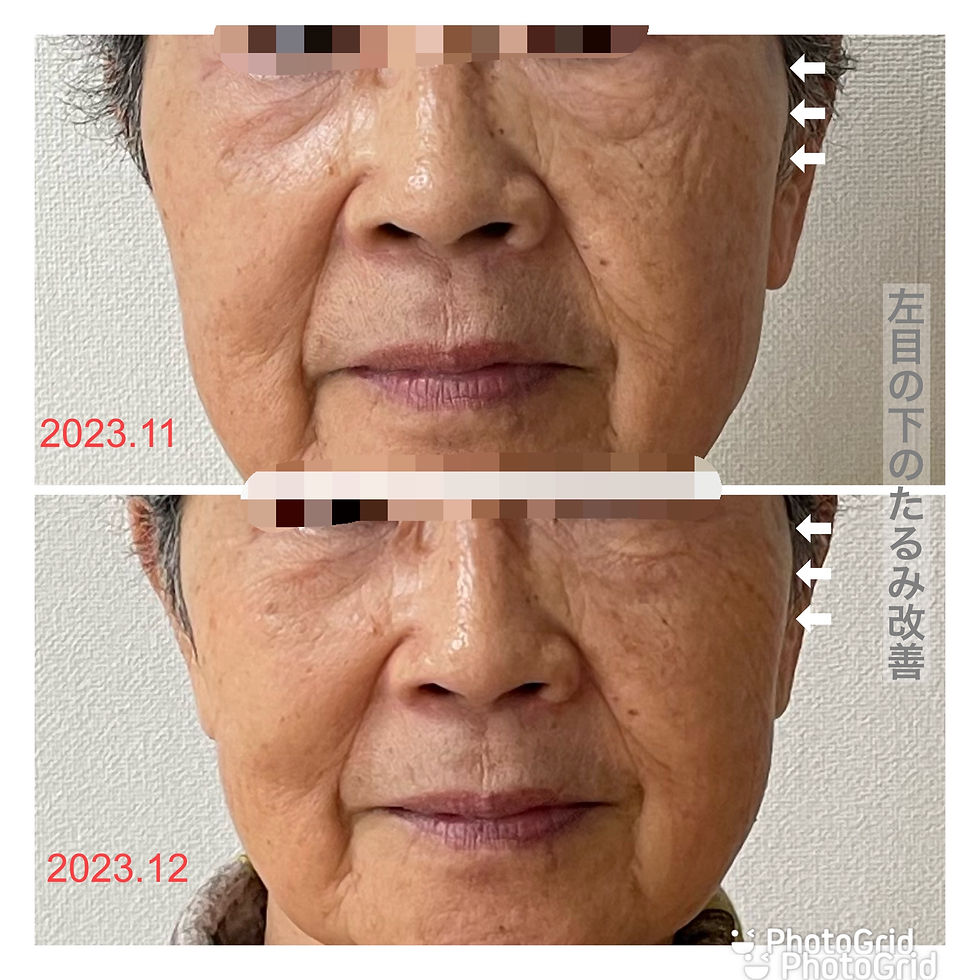 皺たるみの改善したい