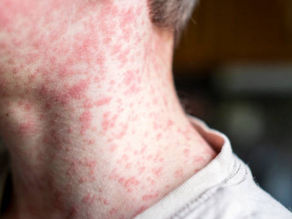 Reportan casos de sarampión en los 32 estados; se registra caso en Puebla