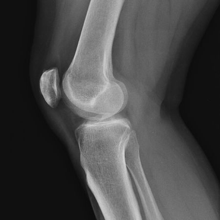 03. Osteoarthritis: Beyond Wear and Tear 