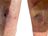 Refractory Squamous Cell Carcinoma