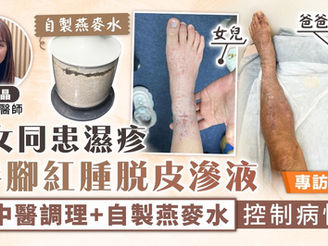 濕疹護理︳父女同患濕疹 手腳紅腫脫皮滲液 中醫調理+自製燕麥水控制病情