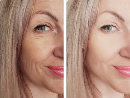 before and after photo of a blonde woman smiling