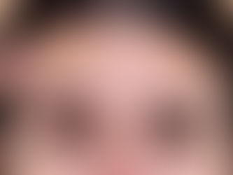 Hoe Botox Een Onderdeel Kan Zijn van Je Preventieve Huidverzorgingsroutine