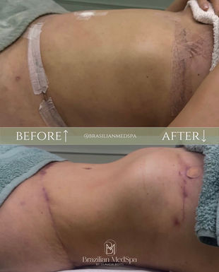 drainage lymphatic post surgery advanced aesthetic liverpool