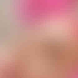 Botox Image 4