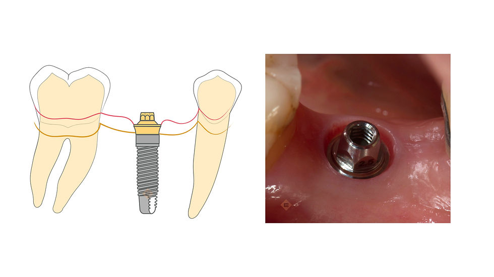 Close-up view of dental implant model on a white background