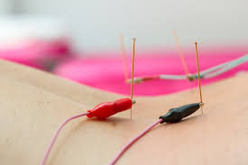 electroacupuncture for back pain