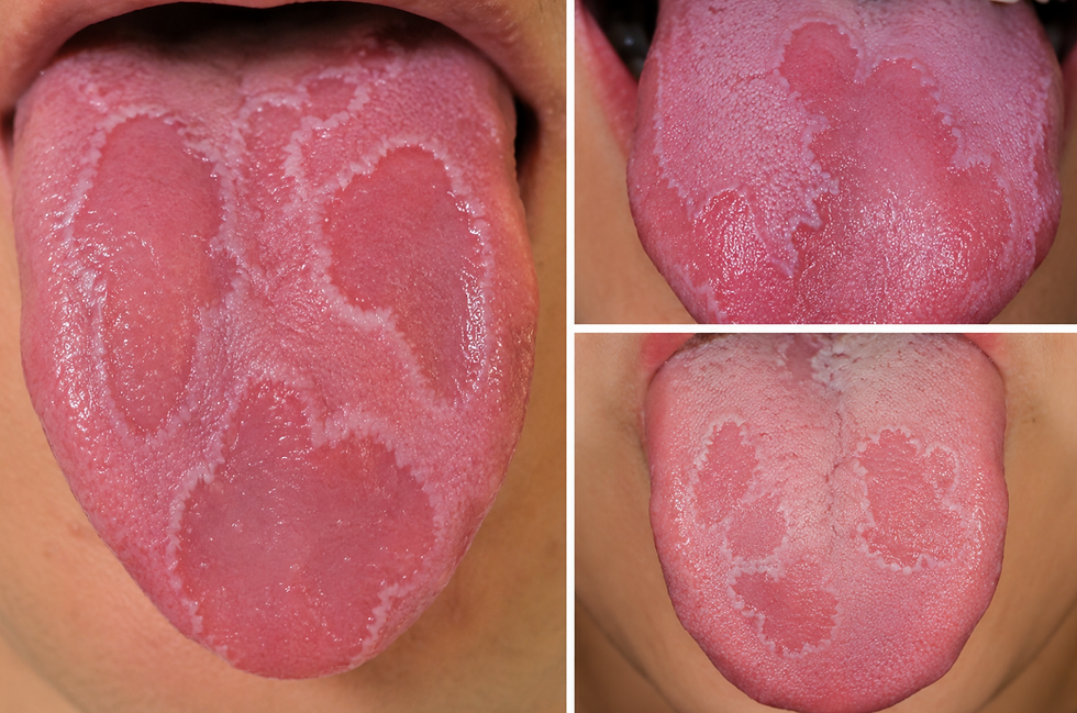Geographic Tongue, benign migratory glossitis