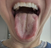 interesting findings is something called geographic tongue