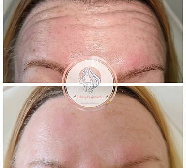 frown lines botox near me