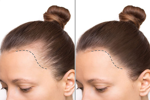 cropped-before-after-head-shot-young-woman-with-bald-patches-her-forehead-temples.jpg