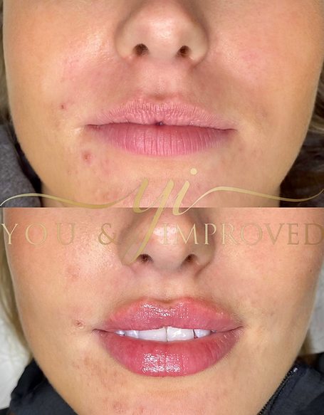 lip enhancement