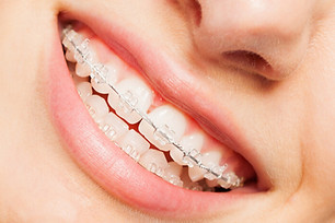 ceramic braces.jpg