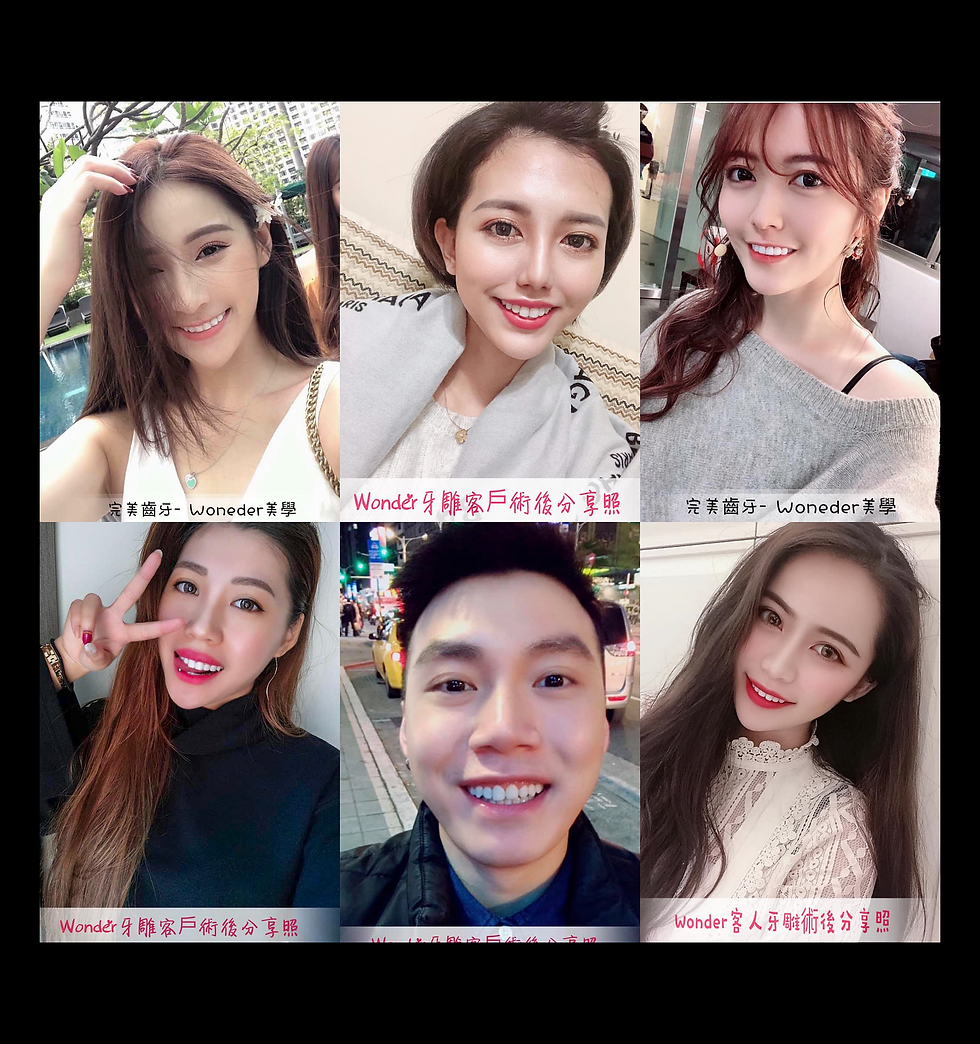 #瓷化貼面 #美容牙齒 #牙齒美白