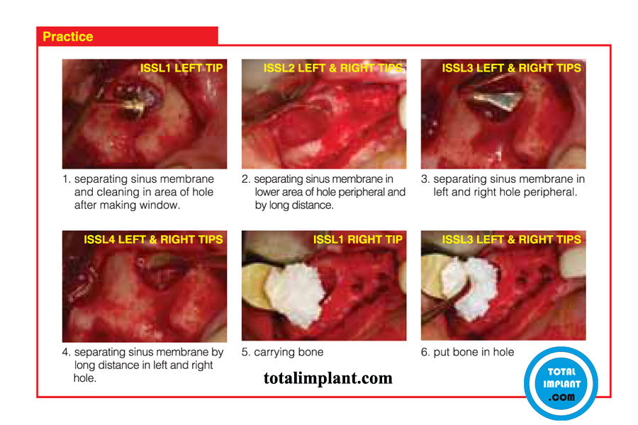 Dental Lateral Approach Surgical Kit