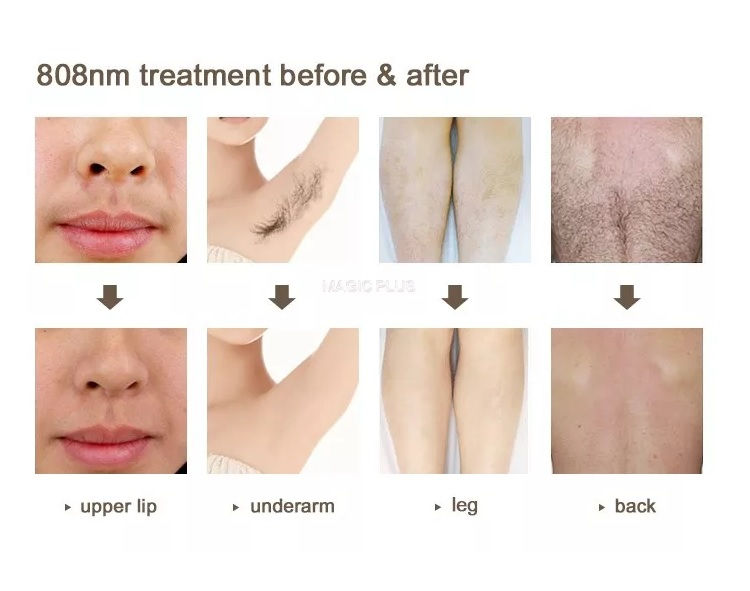 الصورة المصغرة: Diode Laser Hair Removal Machine, 808nm Laser Facial Near Me Treatment