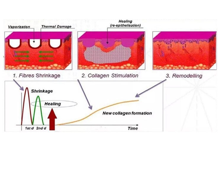 サムネイル： Co2 Fractional Laser Machine,  Vaginal Treatment Scar Pigment Tattoo Removal