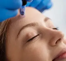 a women getting microneedling with PRP/PRF