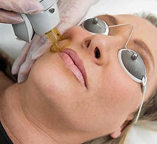 a women getting mole removed from upper lipwith laser