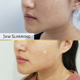 Jaw Slimming