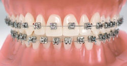 Aparelho Autoligado Manhuaçu