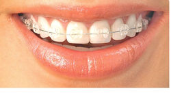 Aparelho Ortodôntico SAFIRA