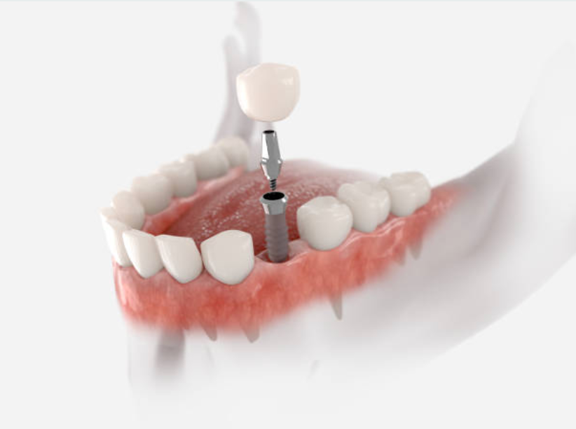 Dental implants Astana