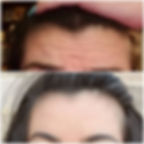 Before/After Botox