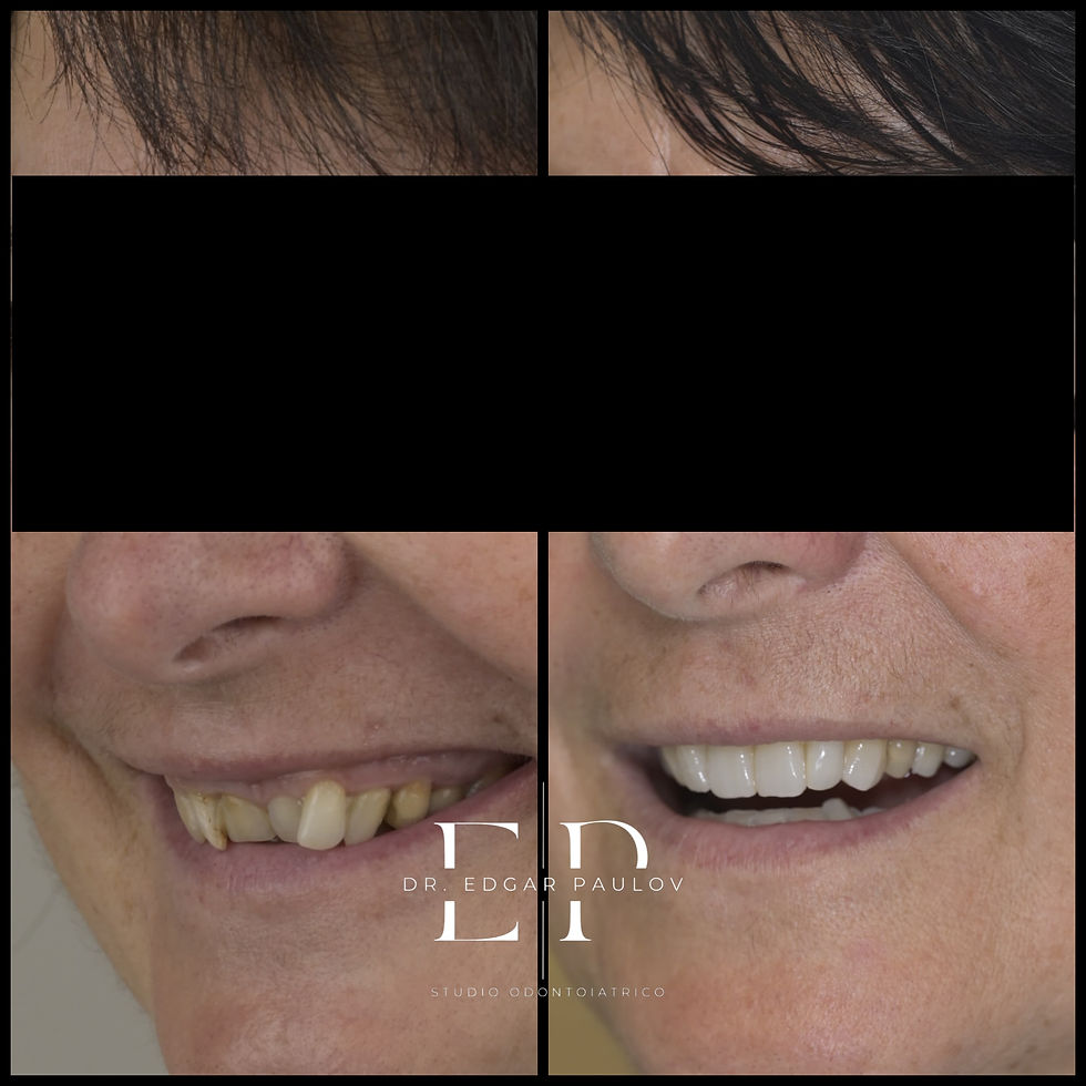 Invisilign + Faccette dentali