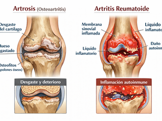 Ilustración médica comparativa de rodilla mostrando las diferencias entre artrosis (osteoartritis) y artritis reumatoide. En la artrosis se observa degeneración progresiva del cartílago articular, estrechamiento del espacio articular, esclerosis subcondral y formación de osteofitos. En la artritis reumatoide se aprecia inflamación de la membrana sinovial (sinovitis), proliferación del pannus, acumulación de líquido sinovial inflamatorio y erosión ósea de origen autoinmune.