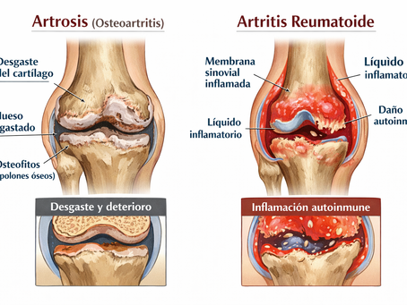 Ilustración médica comparativa de rodilla mostrando las diferencias entre artrosis (osteoartritis) y artritis reumatoide. En la artrosis se observa degeneración progresiva del cartílago articular, estrechamiento del espacio articular, esclerosis subcondral y formación de osteofitos. En la artritis reumatoide se aprecia inflamación de la membrana sinovial (sinovitis), proliferación del pannus, acumulación de líquido sinovial inflamatorio y erosión ósea de origen autoinmune.