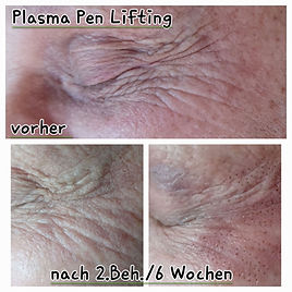 Plasma Pen Lifting Krähenfüße.jpg