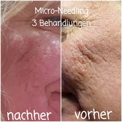 Micro-Needling