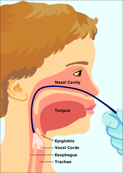 fiberlaryngoscopia-399x560-rd1-esIL.gif