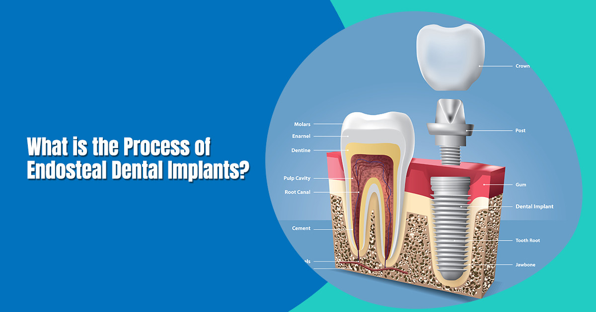What is the Process of Endosteal Dental Implants in Kolkata?