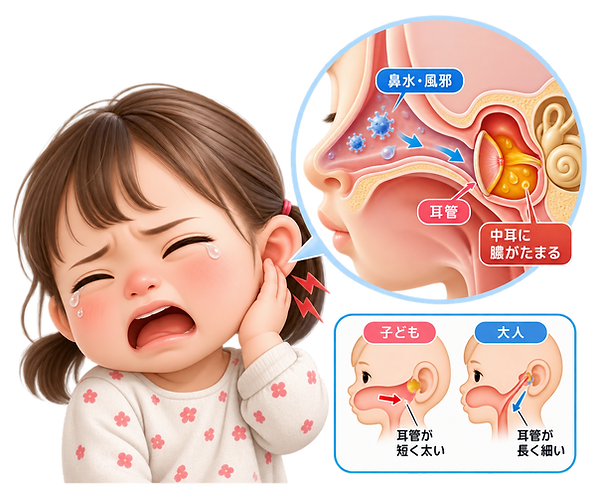 急性中耳炎は大人にも起こりますが、 特に小さなお子さんによくみられます。 子どもは大人に比べて、 鼻と耳をつなぐ「耳管」が 短く、太く、傾きも緩やかなため、 鼻やのどの炎症が中耳へ