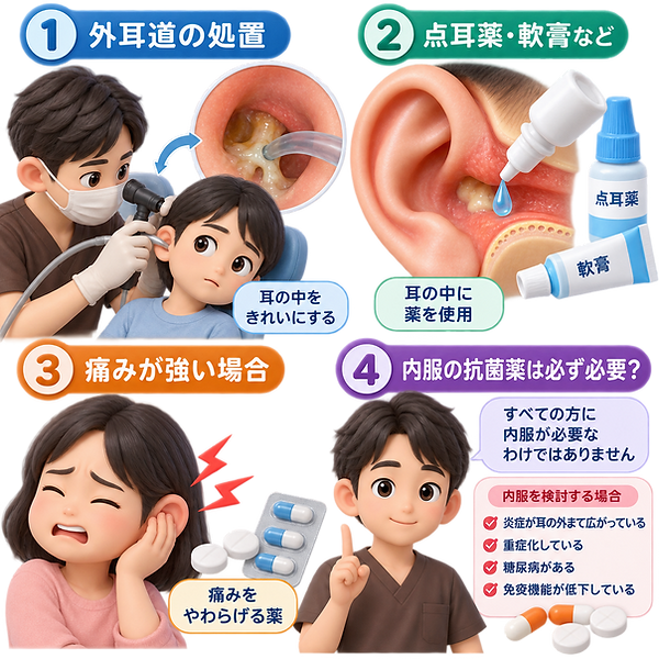 急性外耳炎の治療 急性外耳炎の治療では、炎症の程度と耳の中の状態に合わせて治療することが重要です。 ① 外耳道の処置 耳だれ、耳垢、分泌物などがたまっていると、点耳薬を使用しても炎