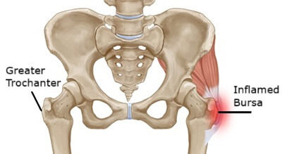 How to Fix Hip Pain from Trochanteric Bursitis: A Simple 6-Week Plan