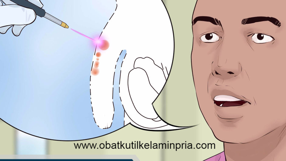 Obat Kutil Kelamin Laki Laki
